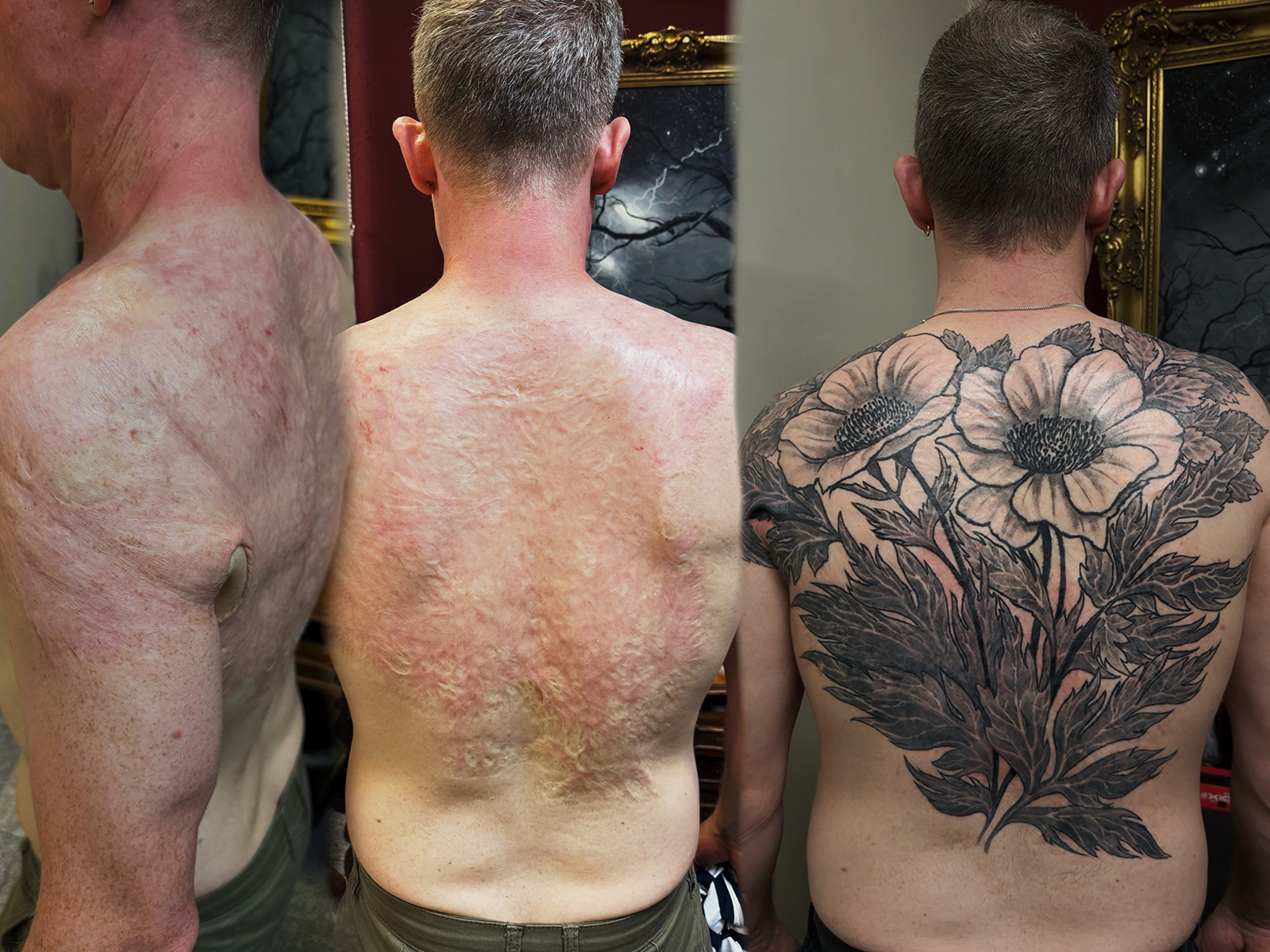 Narben Cover-up nach Brandnarben