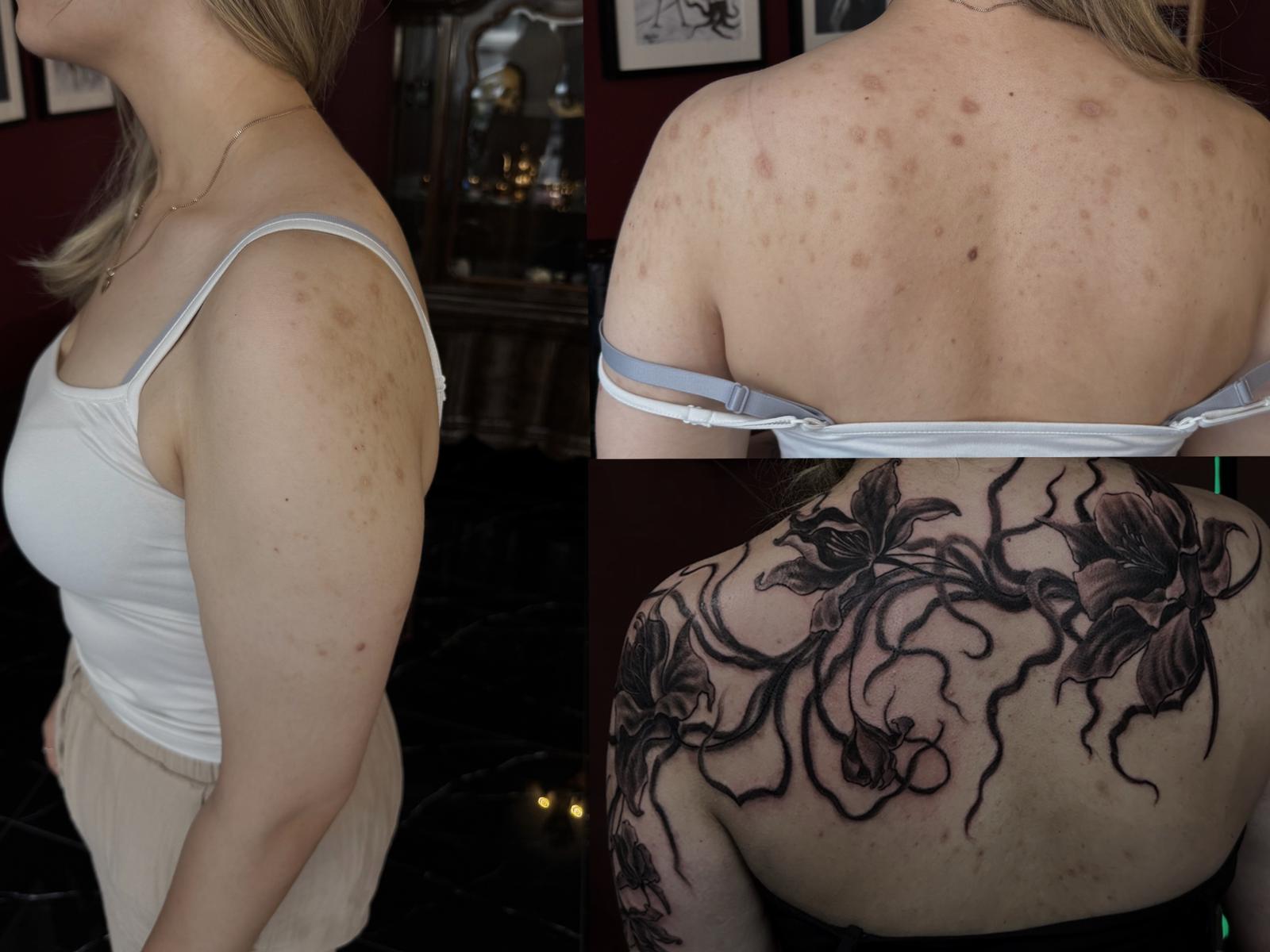 Komplexes Narben Cover-Up an Schultern und Armen in Köln